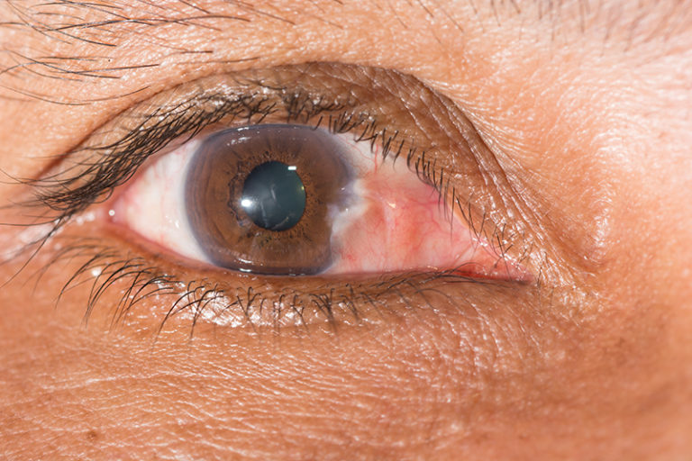 Pterygium West Palm Beach Pinguecula Florida Palm Beach Eye Center